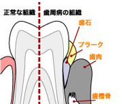 歯周病とは