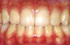 歯周病の進行段階と治療方法